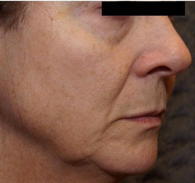 Lip Filler before at Mimi Lee M.D. PA in Little Rock, AR