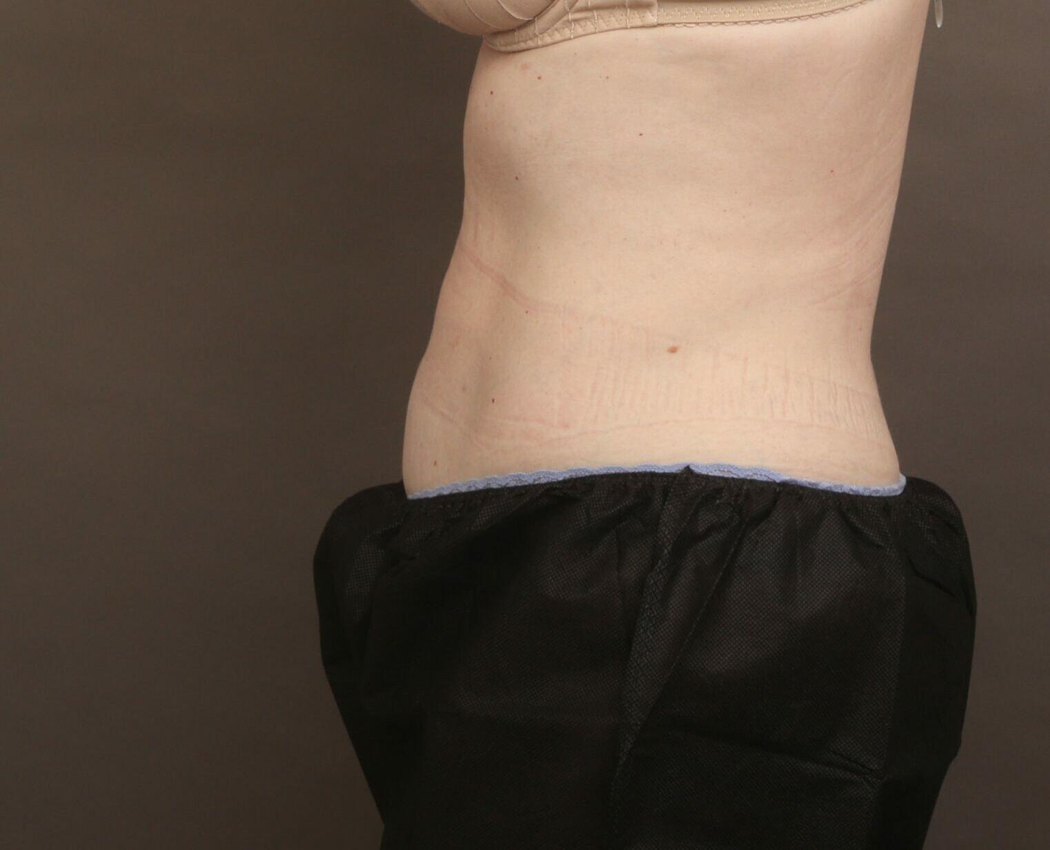 O'Neill Plastic Surgery liposuction after — Charleston, SC