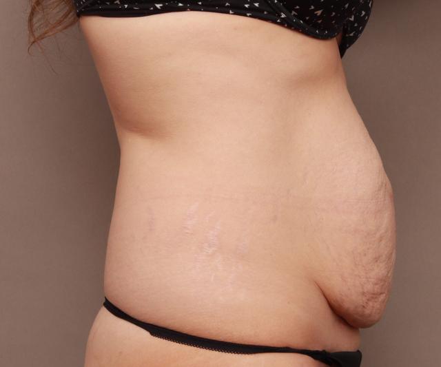 Mini Tummy Tuck before at O'Neill Plastic Surgery in Charleston, SC