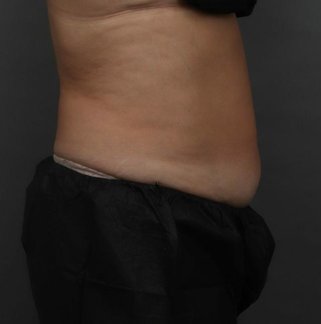 Liposuction before at O'Neill Plastic Surgery in Charleston, SC