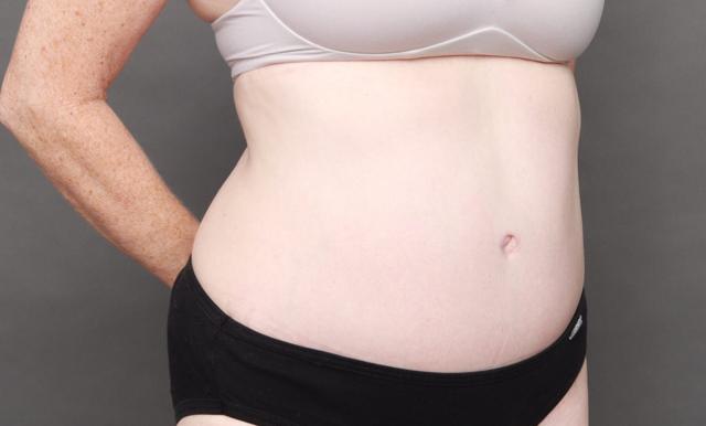 Mini Tummy Tuck after at O'Neill Plastic Surgery in Charleston, SC