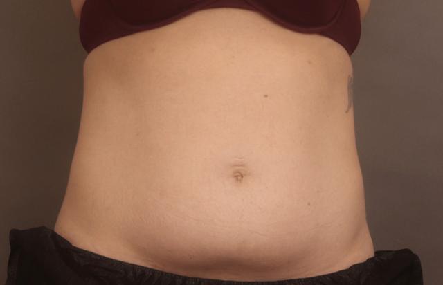 Liposuction before at O'Neill Plastic Surgery in Charleston, SC