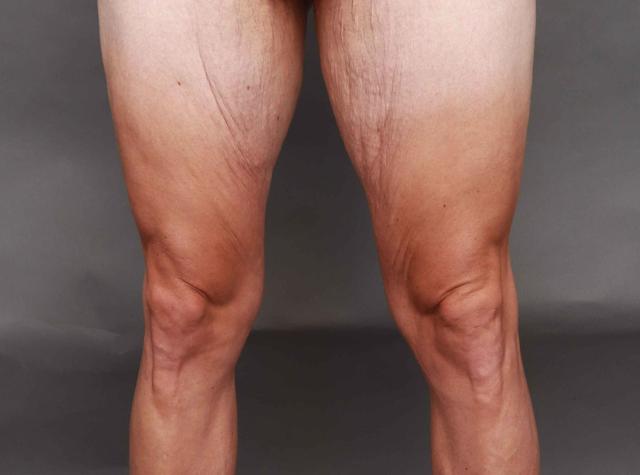 CoolSculpting before at O'Neill Plastic Surgery in Charleston, SC