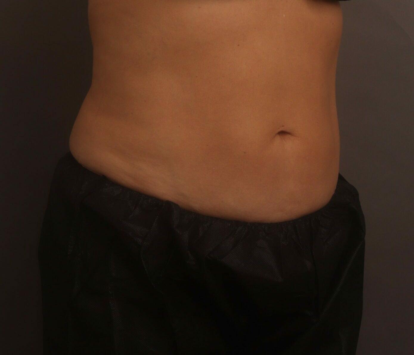 O'Neill Plastic Surgery liposuction after — Charleston, SC