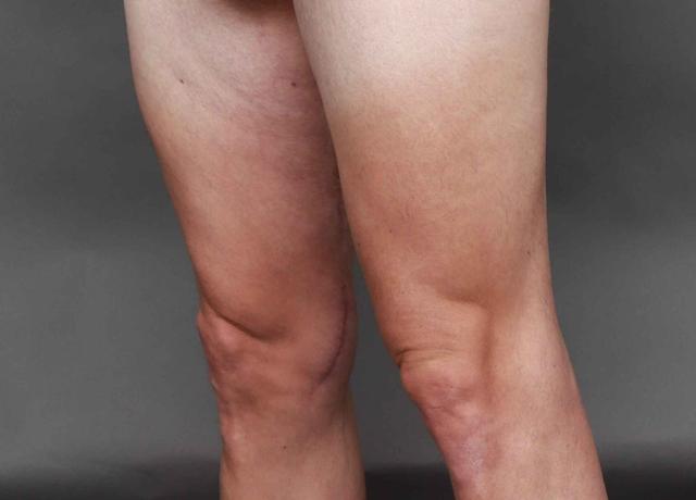 CoolSculpting after at O'Neill Plastic Surgery in Charleston, SC