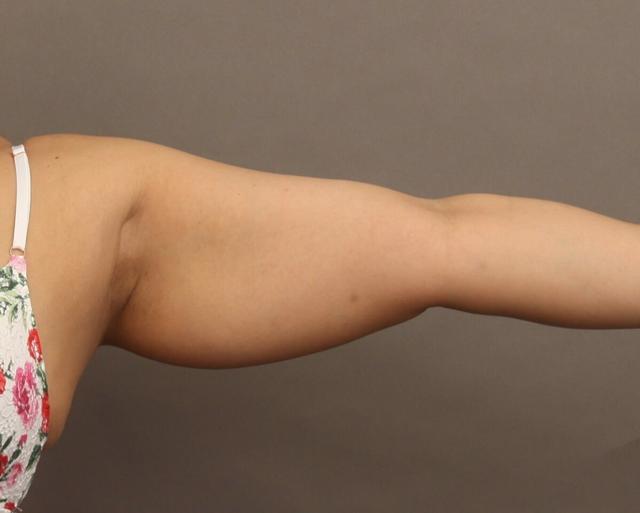 Liposuction before at O'Neill Plastic Surgery in Charleston, SC