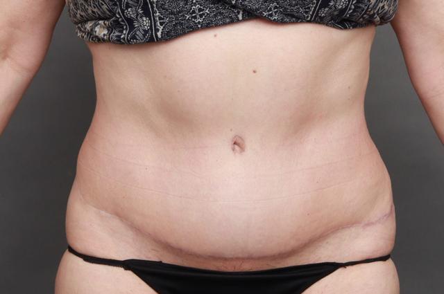 Mini Tummy Tuck after at O'Neill Plastic Surgery in Charleston, SC