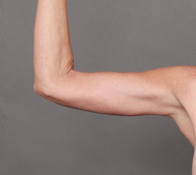 CoolSculpting after at O'Neill Plastic Surgery in Charleston, SC