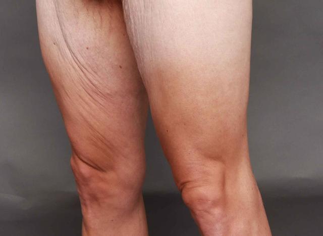 CoolSculpting before at O'Neill Plastic Surgery in Charleston, SC