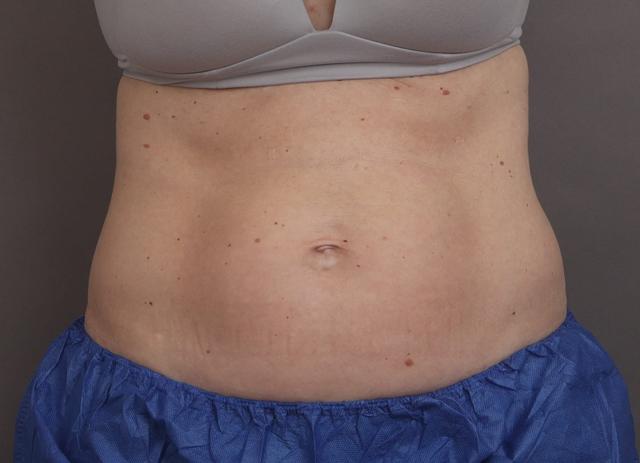 Liposuction before at O'Neill Plastic Surgery in Charleston, SC