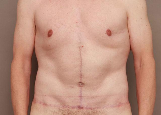 Mini Tummy Tuck after at O'Neill Plastic Surgery in Charleston, SC