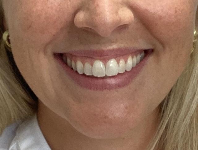 Lip Filler before at O'Neill Plastic Surgery in Charleston, SC