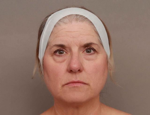 Facelift before at O'Neill Plastic Surgery in Charleston, SC