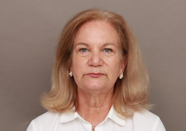 Facelift before at O'Neill Plastic Surgery in Charleston, SC