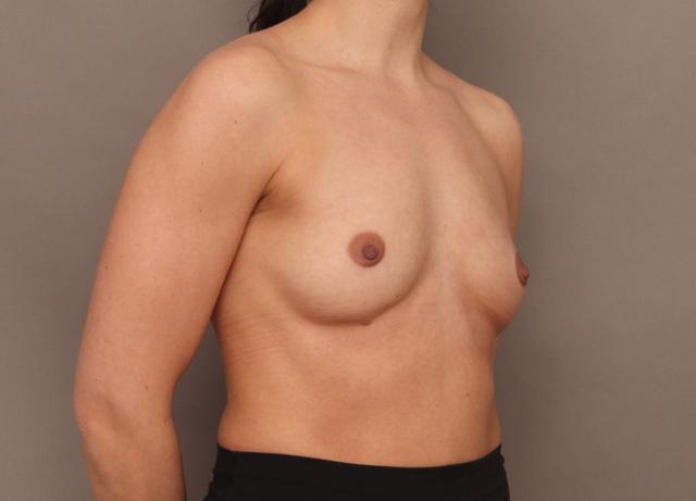 Breast Augmentation before at O'Neill Plastic Surgery in Charleston, SC