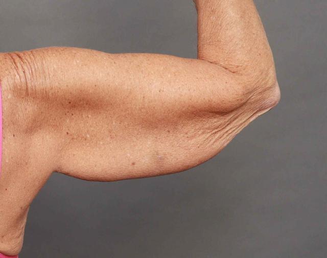 CoolSculpting before at O'Neill Plastic Surgery in Charleston, SC