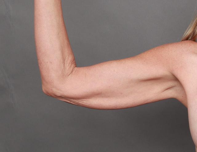 CoolSculpting before at O'Neill Plastic Surgery in Charleston, SC