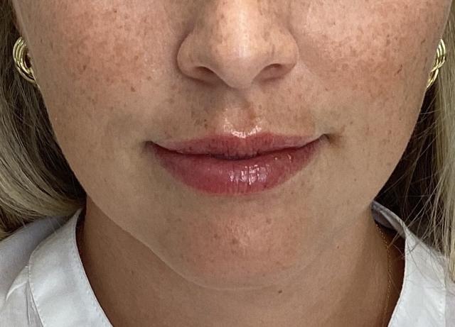 Lip Filler after at O'Neill Plastic Surgery in Charleston, SC