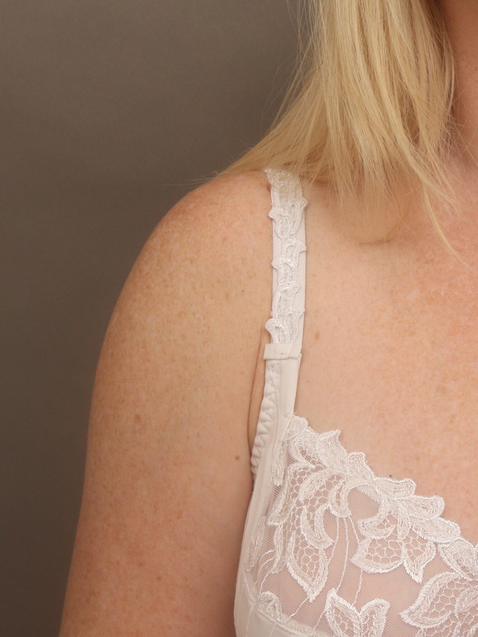 O'Neill Plastic Surgery after — Charleston, SC