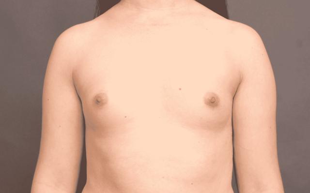 Breast Augmentation before at O'Neill Plastic Surgery in Charleston, SC