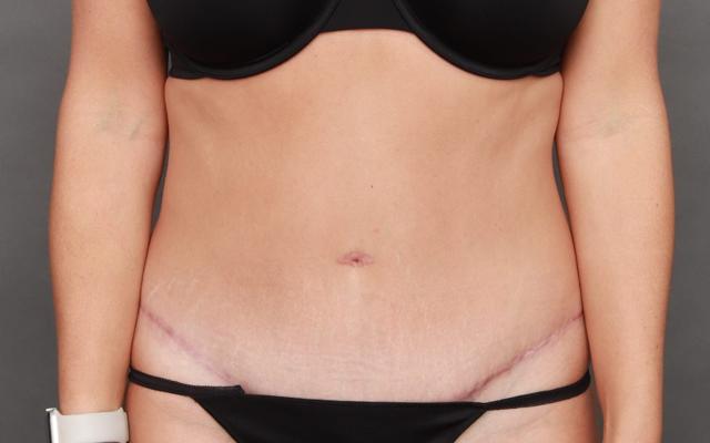 Mini Tummy Tuck after at O'Neill Plastic Surgery in Charleston, SC