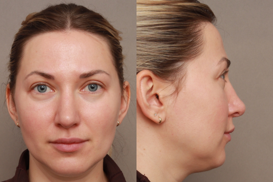 Functional Rhinoplasty after at O'Neill Plastic Surgery in Charleston, SC
