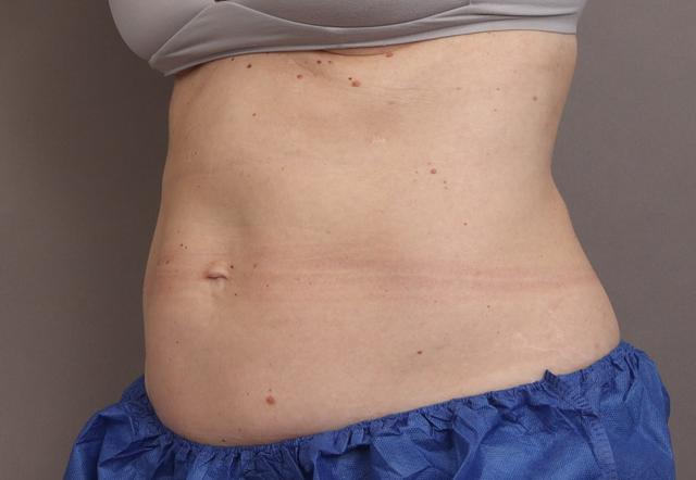 Liposuction after at O'Neill Plastic Surgery in Charleston, SC