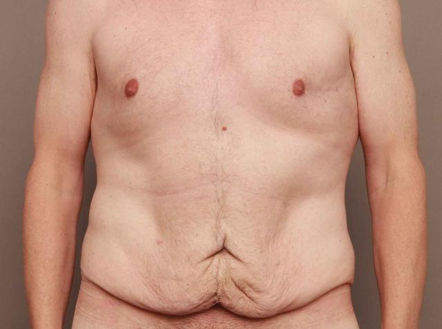Mini Tummy Tuck before at O'Neill Plastic Surgery in Charleston, SC