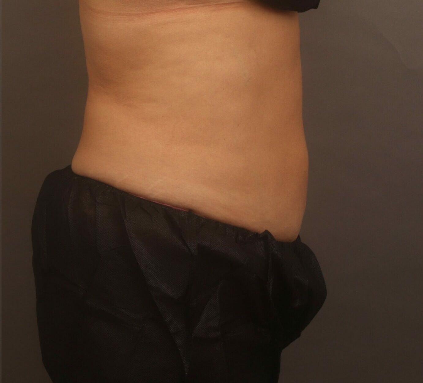 O'Neill Plastic Surgery liposuction after — Charleston, SC