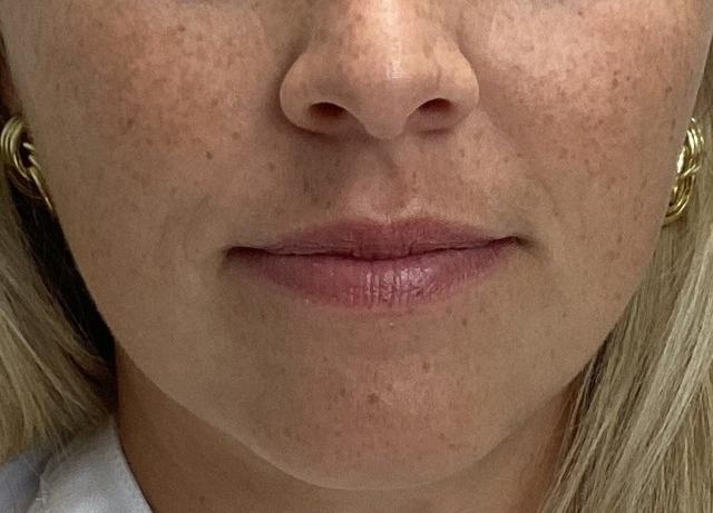 Lip Filler before at O'Neill Plastic Surgery in Charleston, SC