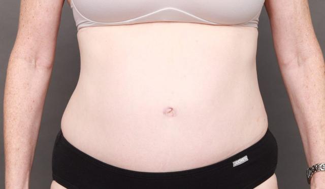 Mini Tummy Tuck after at O'Neill Plastic Surgery in Charleston, SC