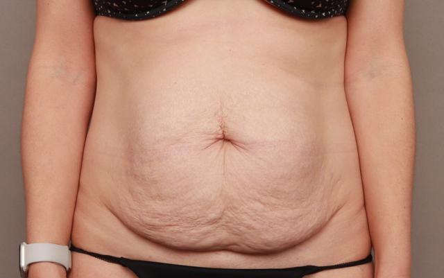 Mini Tummy Tuck before at O'Neill Plastic Surgery in Charleston, SC