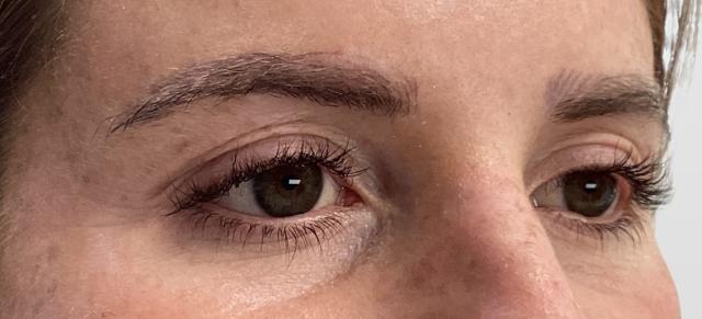 Blepharoplasty before at O'Neill Plastic Surgery in Charleston, SC