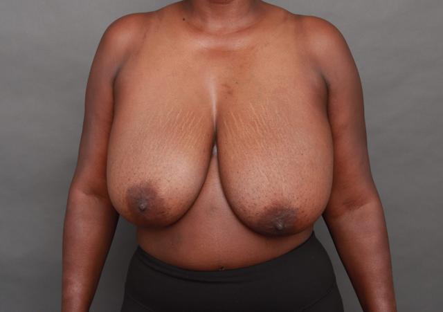 Breast Reduction before at O'Neill Plastic Surgery in Charleston, SC