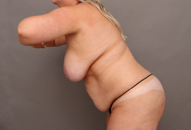 Breast Reduction before at O'Neill Plastic Surgery in Charleston, SC