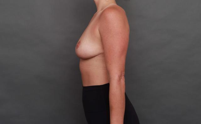 Breast Lift after at O'Neill Plastic Surgery in Charleston, SC