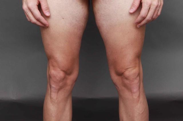 CoolSculpting after at O'Neill Plastic Surgery in Charleston, SC