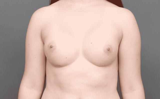 Breast Augmentation after at O'Neill Plastic Surgery in Charleston, SC