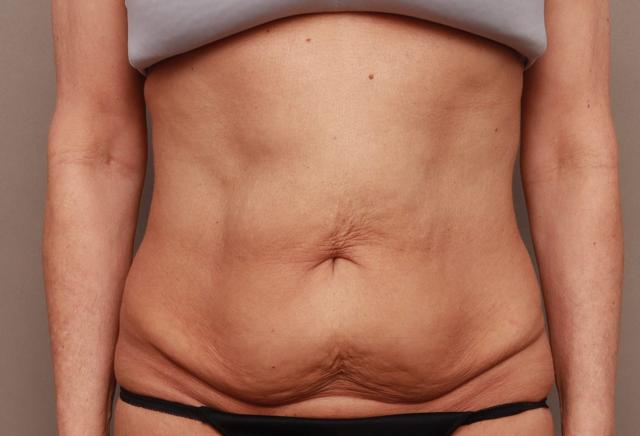 Mini Tummy Tuck before at O'Neill Plastic Surgery in Charleston, SC
