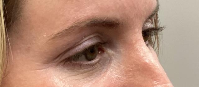 Blepharoplasty after at O'Neill Plastic Surgery in Charleston, SC
