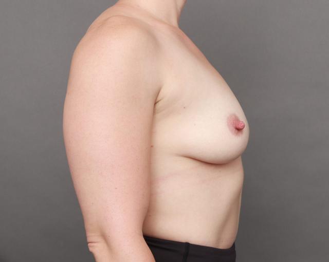 Breast Lift after at O'Neill Plastic Surgery in Charleston, SC