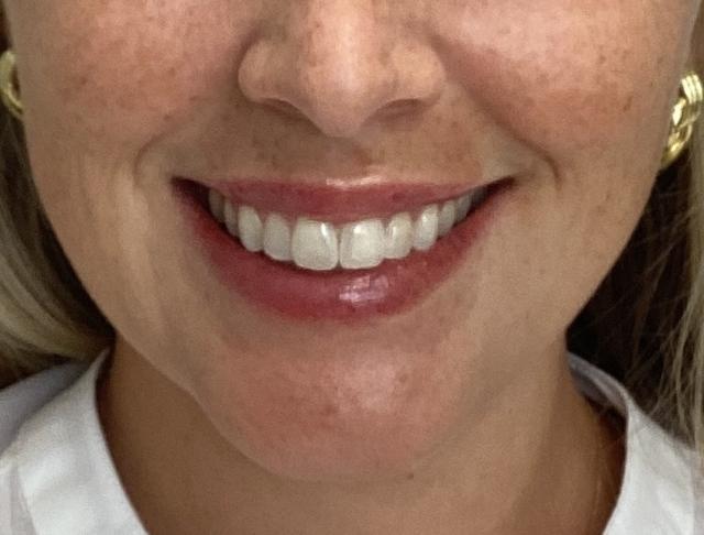 Lip Filler after at O'Neill Plastic Surgery in Charleston, SC