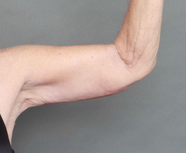 CoolSculpting after at O'Neill Plastic Surgery in Charleston, SC