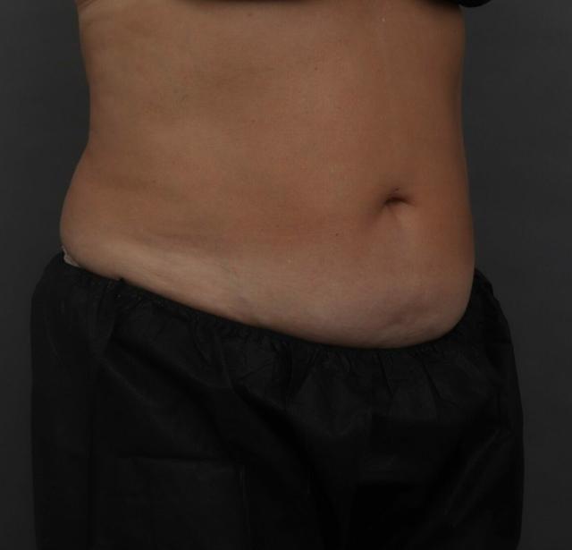 Liposuction before at O'Neill Plastic Surgery in Charleston, SC