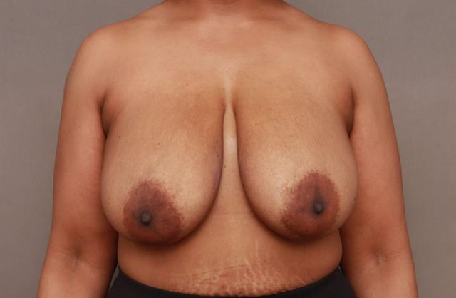 Breast Reduction before at O'Neill Plastic Surgery in Charleston, SC