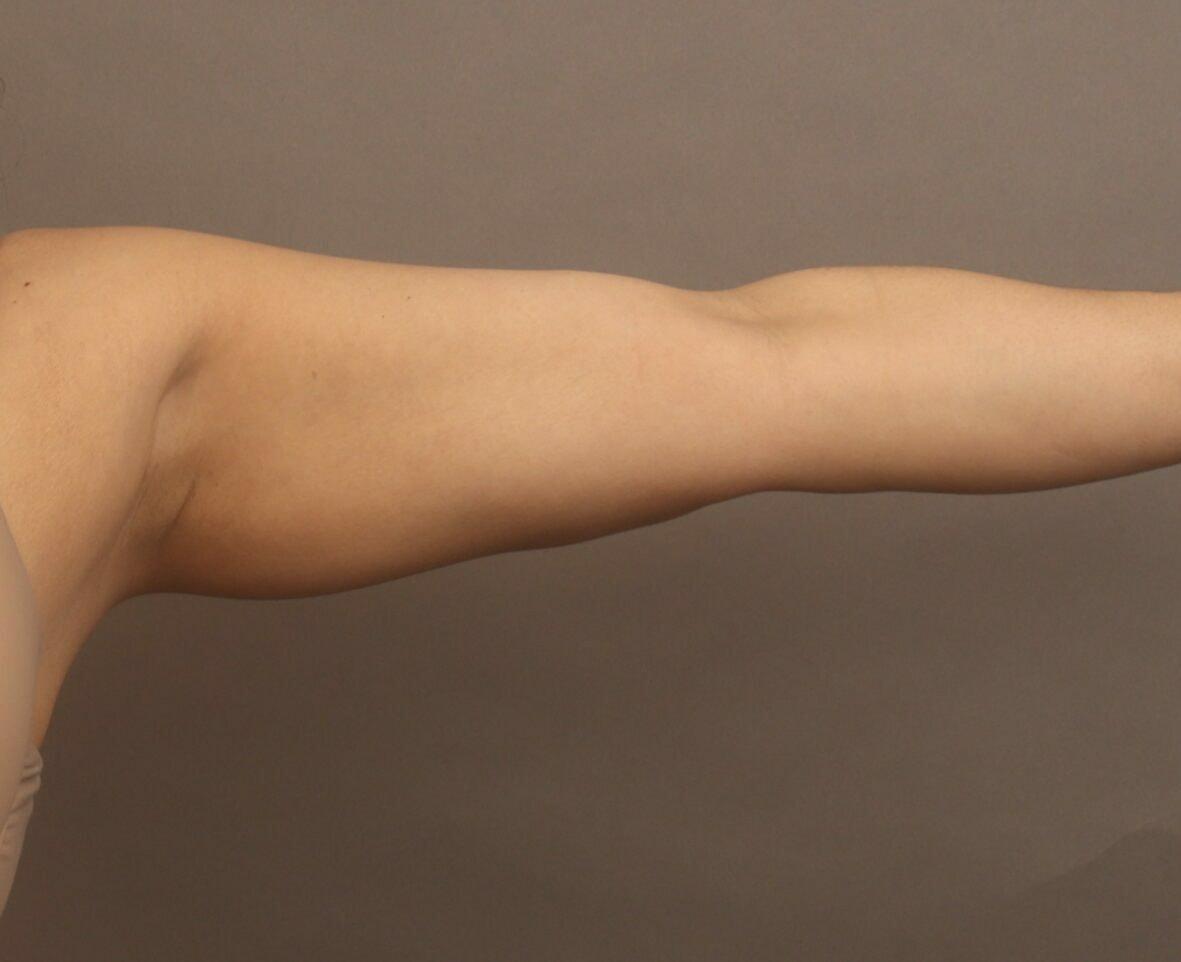 O'Neill Plastic Surgery liposuction after — Charleston, SC