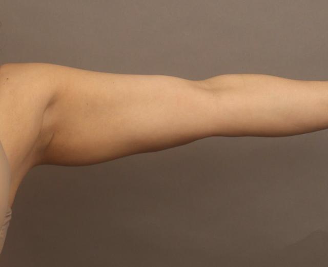 Liposuction after at O'Neill Plastic Surgery in Charleston, SC
