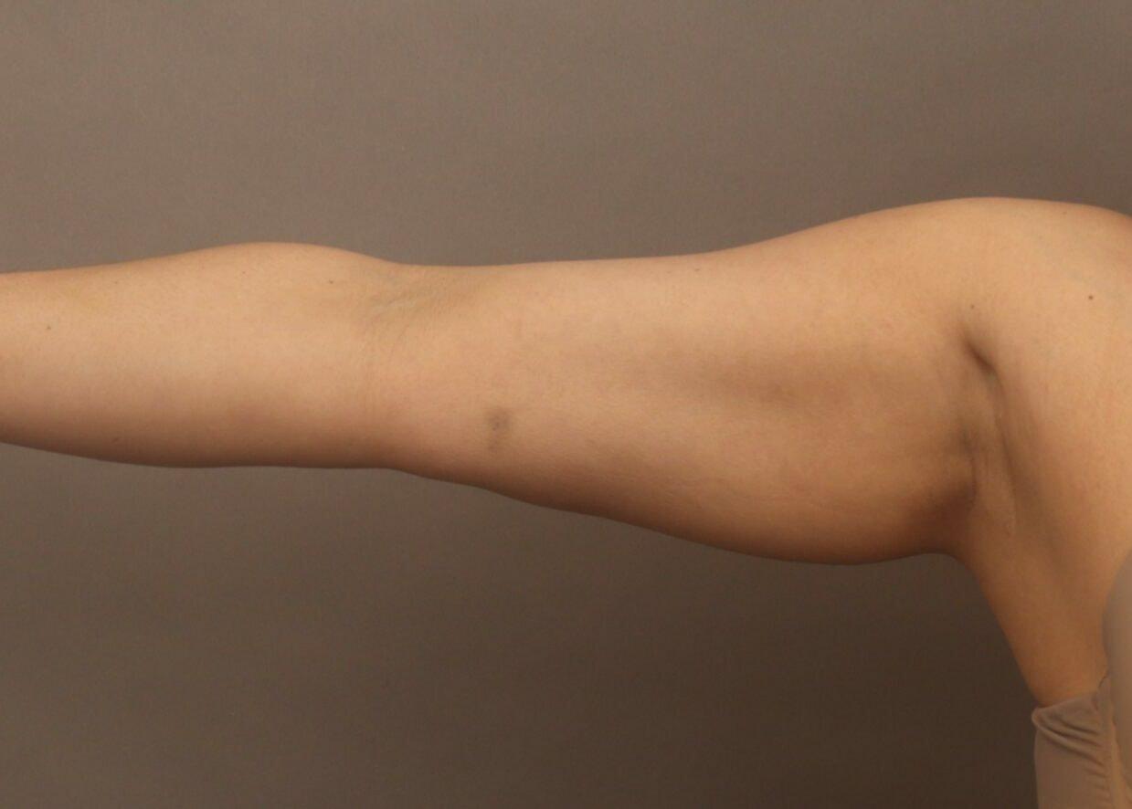 O'Neill Plastic Surgery liposuction after — Charleston, SC