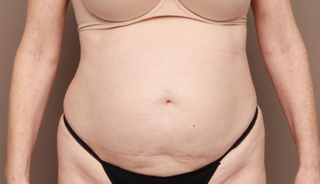 Mini Tummy Tuck before at O'Neill Plastic Surgery in Charleston, SC