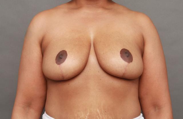 Breast Reduction after at O'Neill Plastic Surgery in Charleston, SC